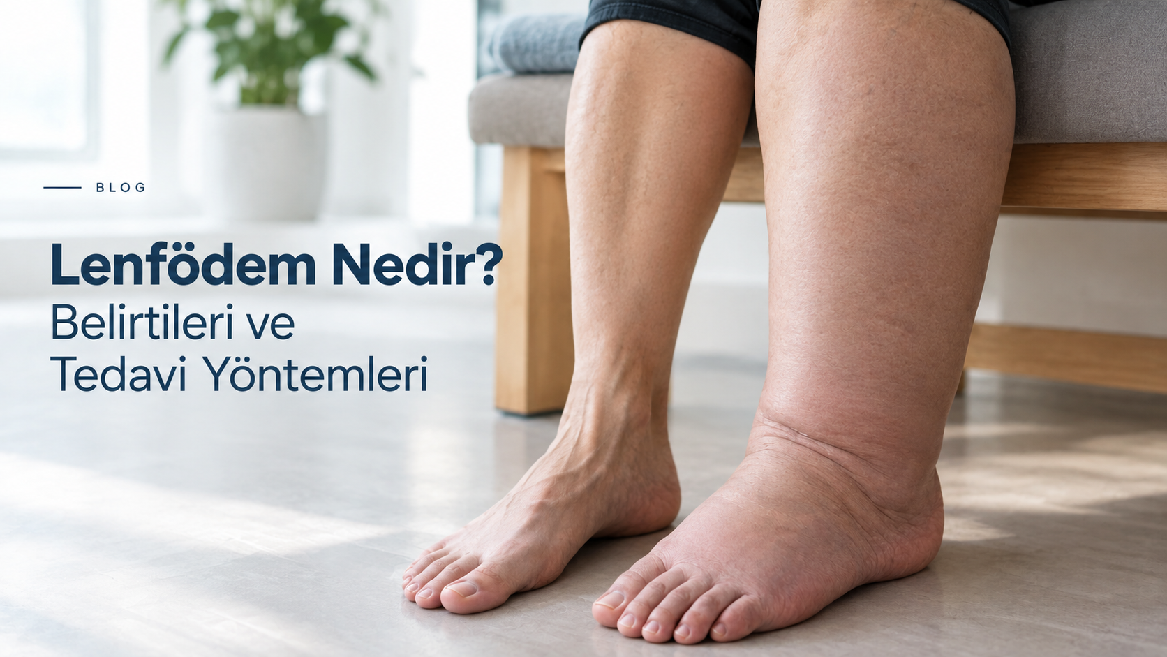 Lenfödem Nedir? Belirtileri ve Tedavi Yöntemleri